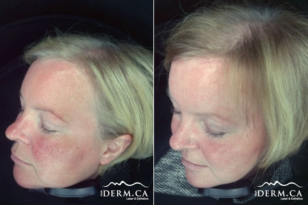 A patient before and after Anti Redness / Rosacea Laser treatment