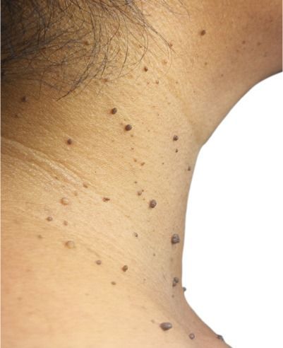A person's neck with moles