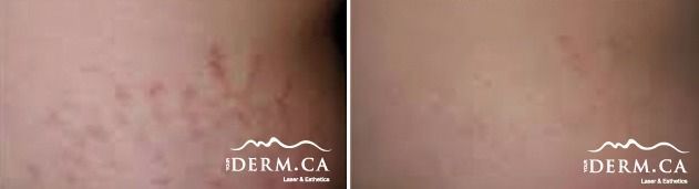Skin before and after stretch marks treatment