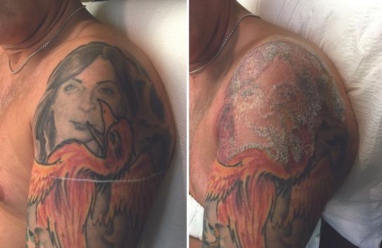 Person before and after Laser Tattoo removal