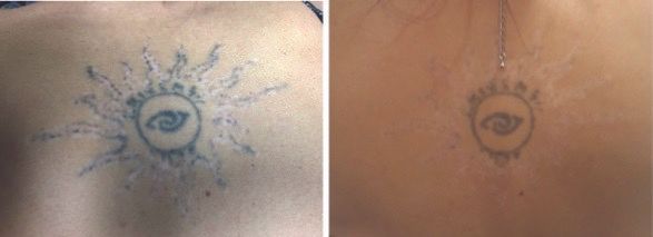 Person before and after Laser Tattoo removal