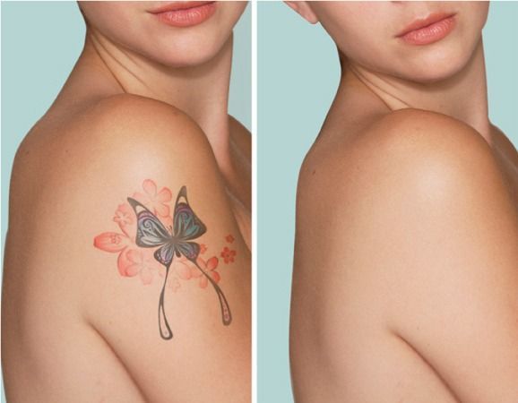 Patient before and after tattoo removal