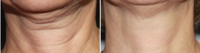A person before and after the titan laser treatment