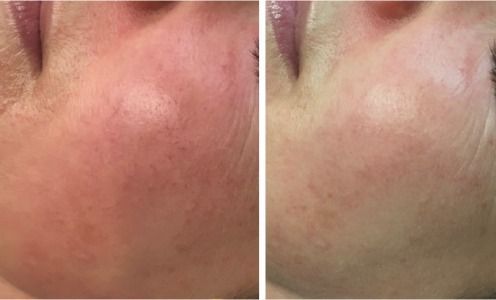 Patient before and after Laser Genesis