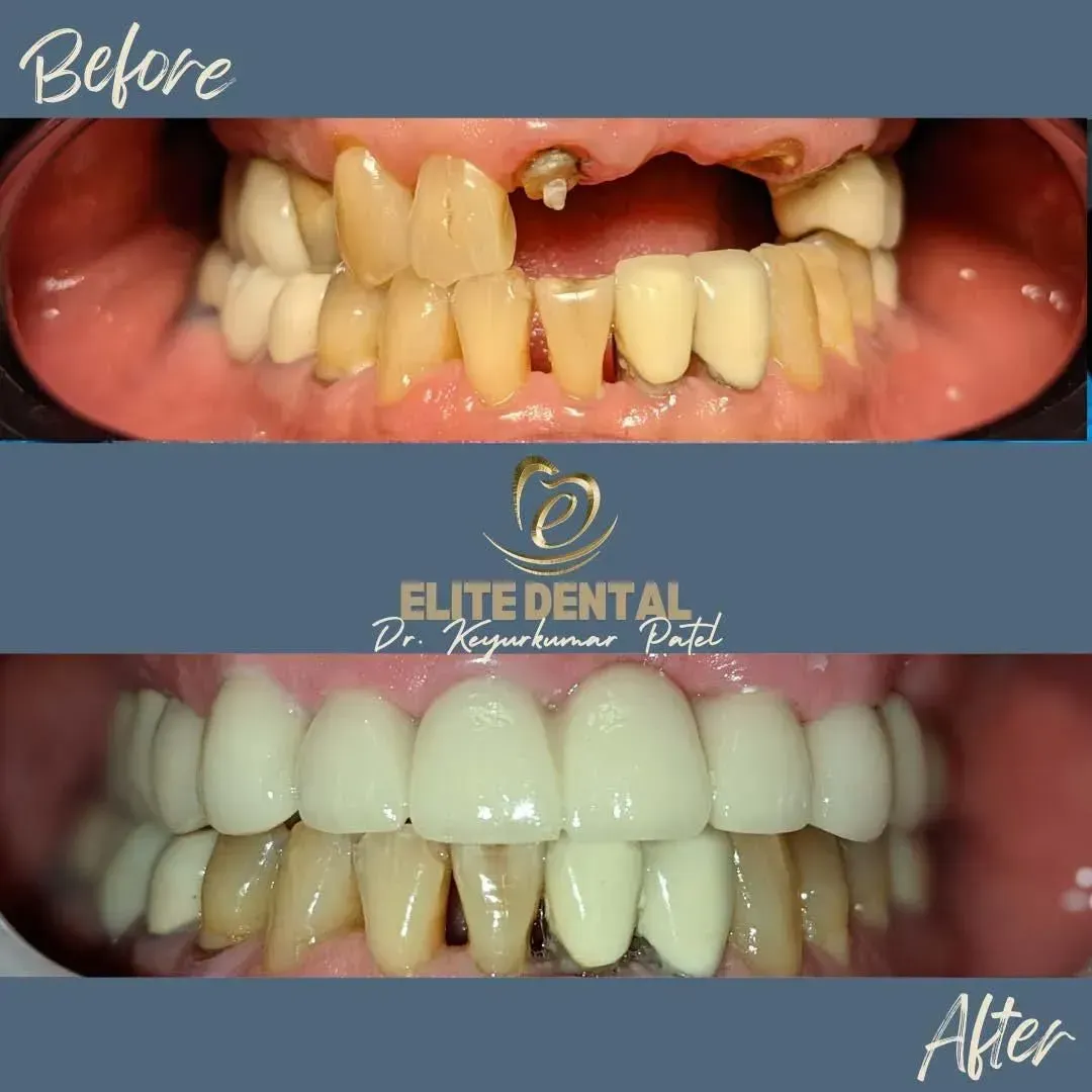 A before and after picture of a person 's teeth from elite dental