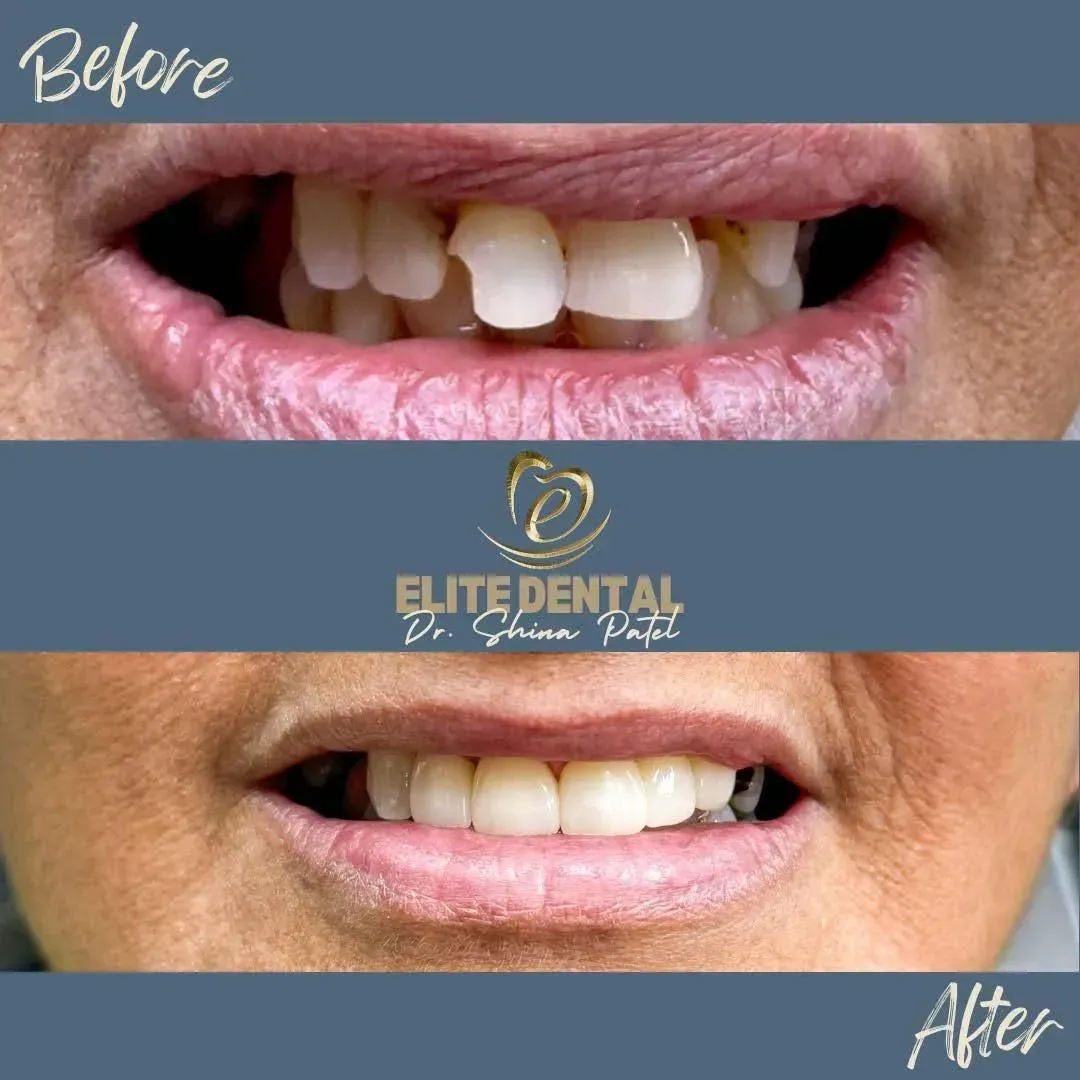 A before and after photo of a woman 's teeth from elite dental