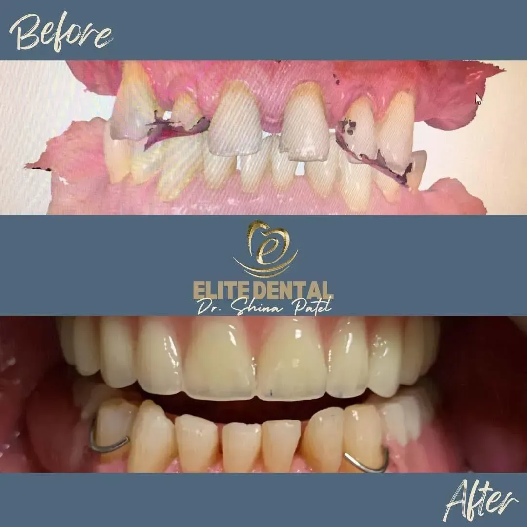 A before and after picture of a person 's teeth from elite dental