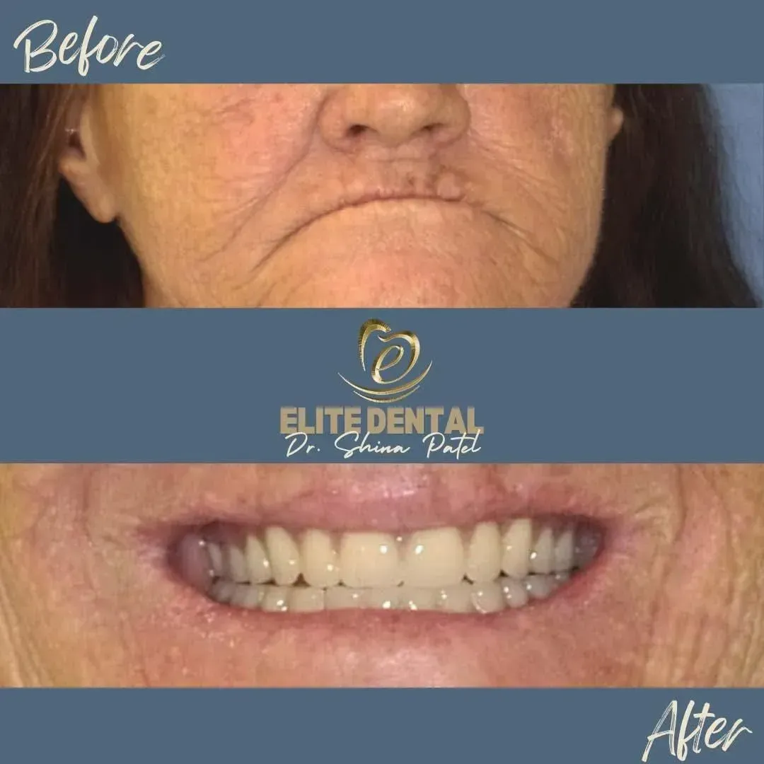 A before and after photo of a woman 's face by elite dental