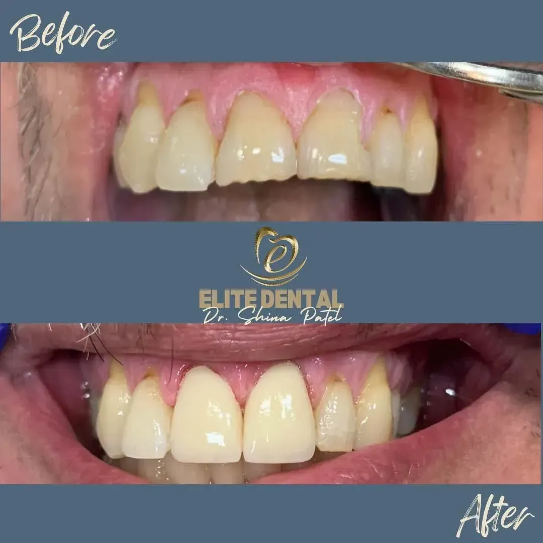 A before and after picture of a person 's teeth from elite dental