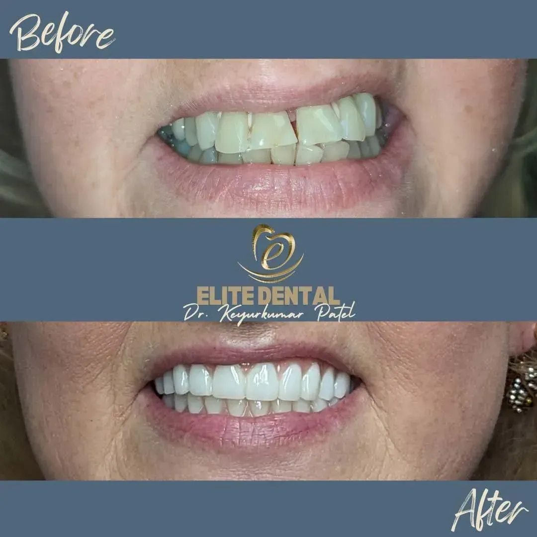 A before and after picture of a woman 's teeth from elite dental