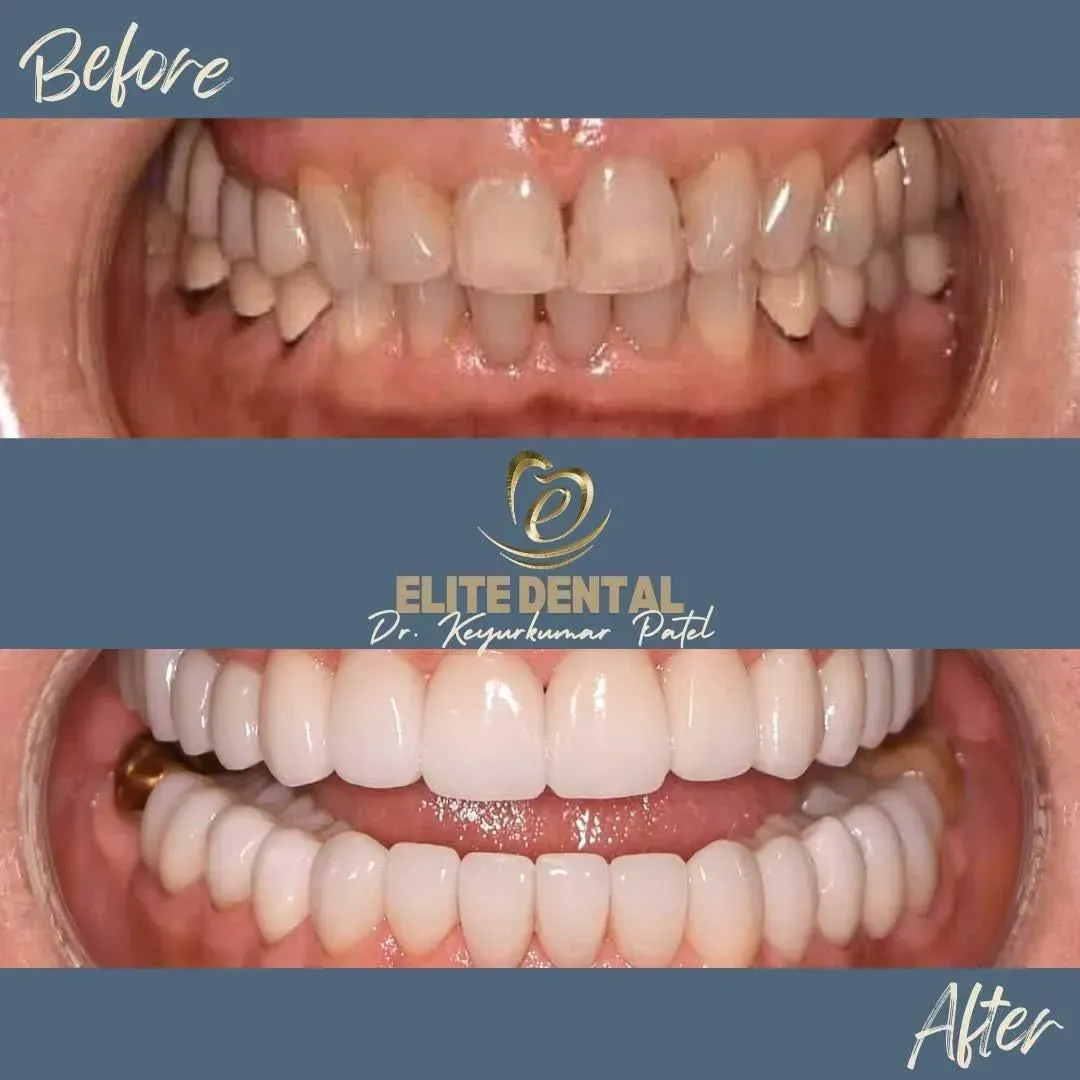 A before and after picture of a person 's teeth from elite dental
