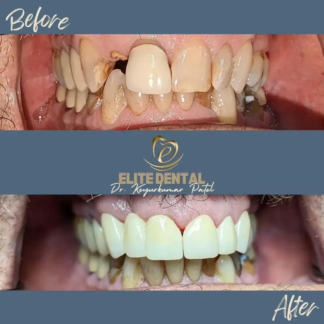 A before and after picture of a person 's teeth from elite dental