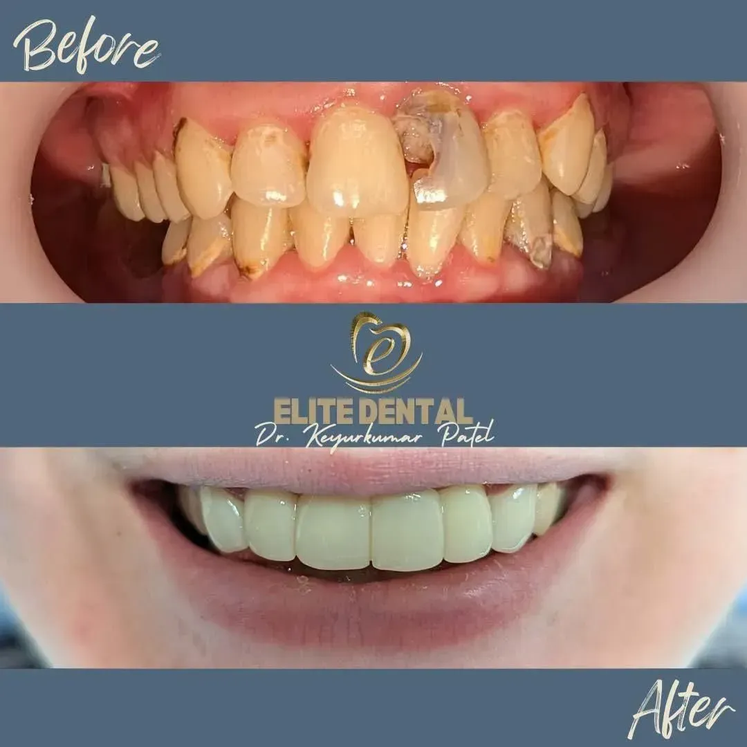 A before and after picture of a person 's teeth from elite dental