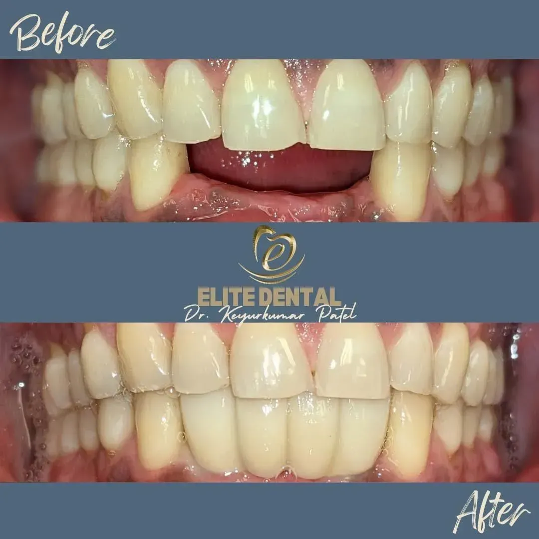 A before and after picture of a person 's teeth from elite dental
