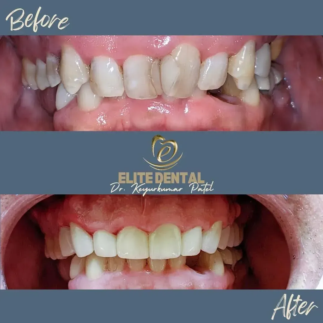 A before and after picture of a person 's teeth from elite dental