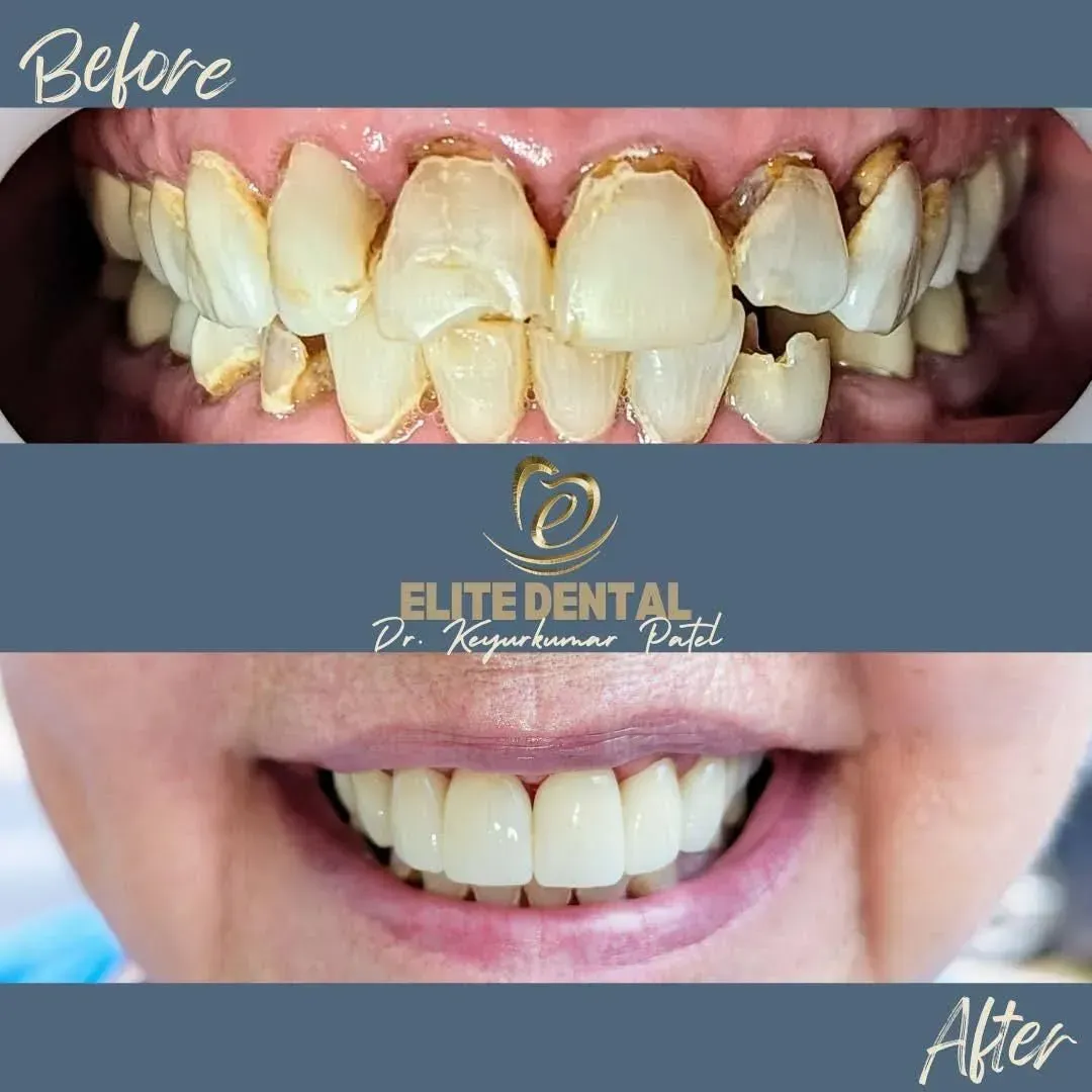 A before and after picture of a woman 's teeth from elite dental