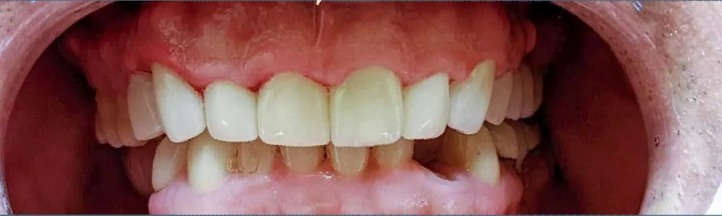 A close up of a person 's teeth with white teeth.