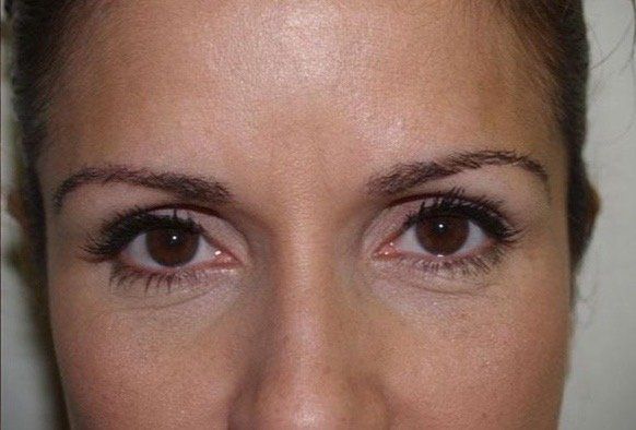 Eyebrow Hair Transplant Clinic Melbourne