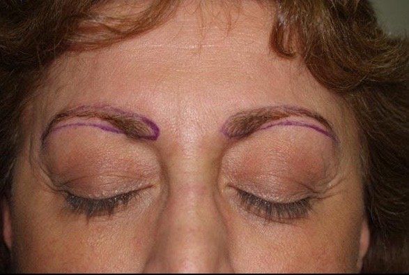 Eyebrow Transplant Before