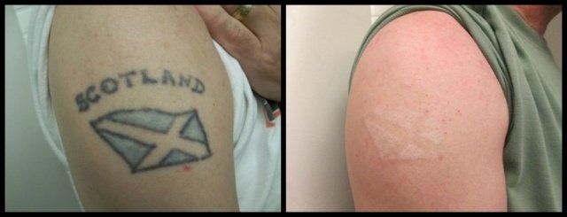 Arm Tattoo - Color Ink Laser Tattoo Removal Before and After