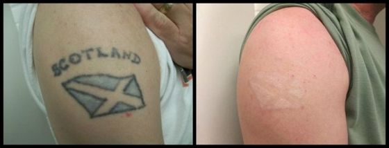 Arm Tattoo - Color Ink Laser Tattoo Removal Before and After