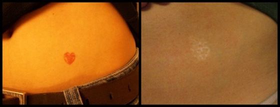 Hip Tattoo - Red Ink Laser Tattoo Removal Before and After