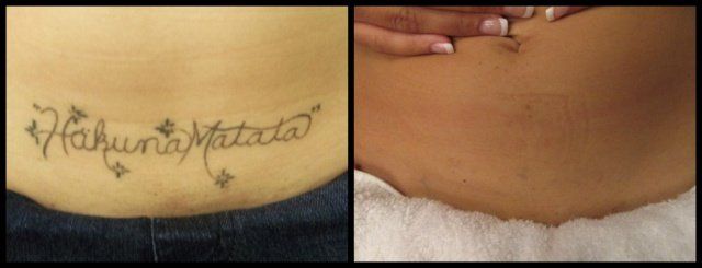 Text Tattoo - Black Ink Laser Tattoo Removal Before and After