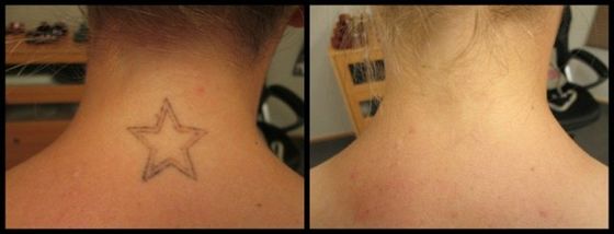 Neck Tattoo - Black Ink Laser Tattoo Removal Before and After