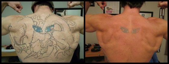 Back Tattoo - Green Ink Laser Tattoo Removal Before and After