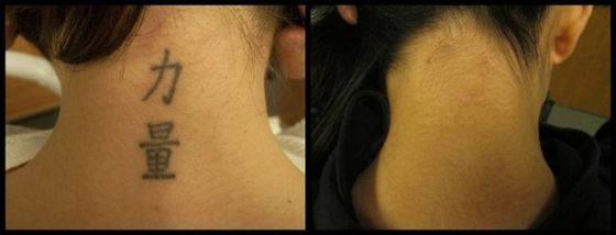 Neck Symbol Tattoo - Black Ink Laser Tattoo Removal Before and After