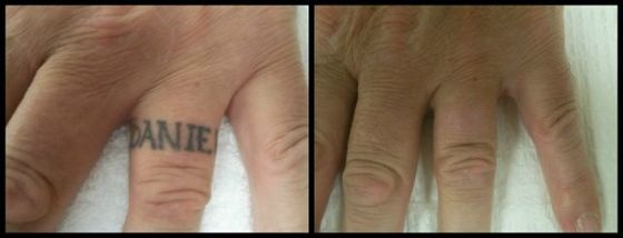 Finger Tattoo - Black Ink Laser Tattoo Removal Before and After