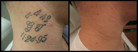 Neck Text Tattoo - Black Ink Laser Tattoo Removal Before and After