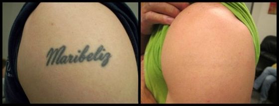 Arm Text Tattoo - Black Ink Laser Tattoo Removal Before and After