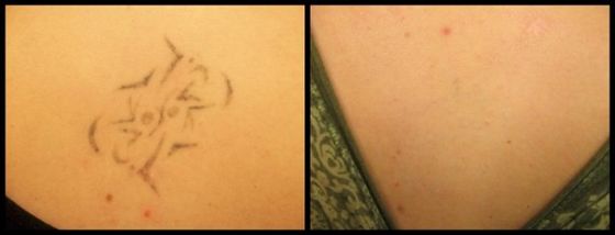 Faded Tattoo - Black Ink Laser Tattoo Removal Before and After
