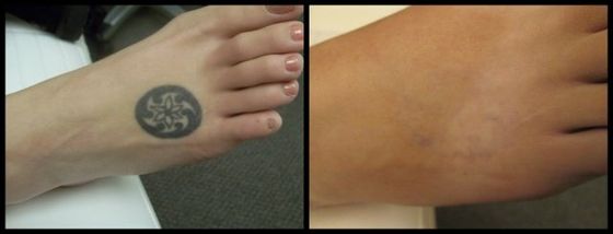 Foot Tattoo - Black Ink Laser Tattoo Removal Before and After