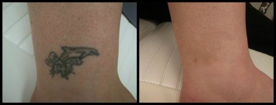 Ankle Tattoo - Color Ink Laser Tattoo Removal Before and After