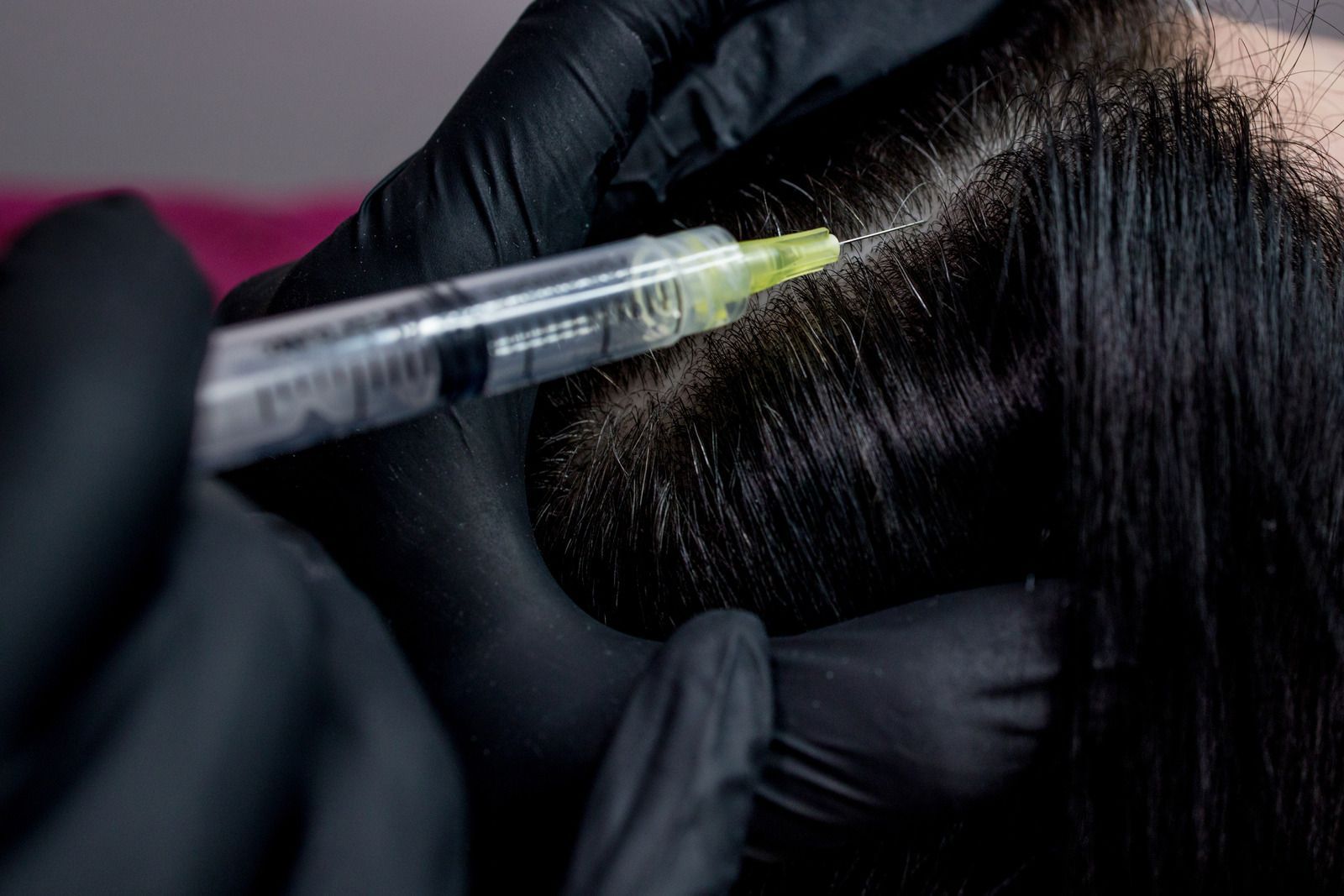 Person receiving a scalp injection for hair loss treatment; black gloved hands, syringe, dark hair.