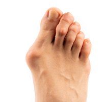 Foot With Bunion — Newport, RI — Newport Family Foot Care
