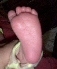 Baby's Foot — Newport, RI — Newport Family Foot Care