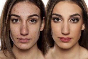 Theraclear — Shelby Township, MI — Dermatology Specialists of Shelby Township