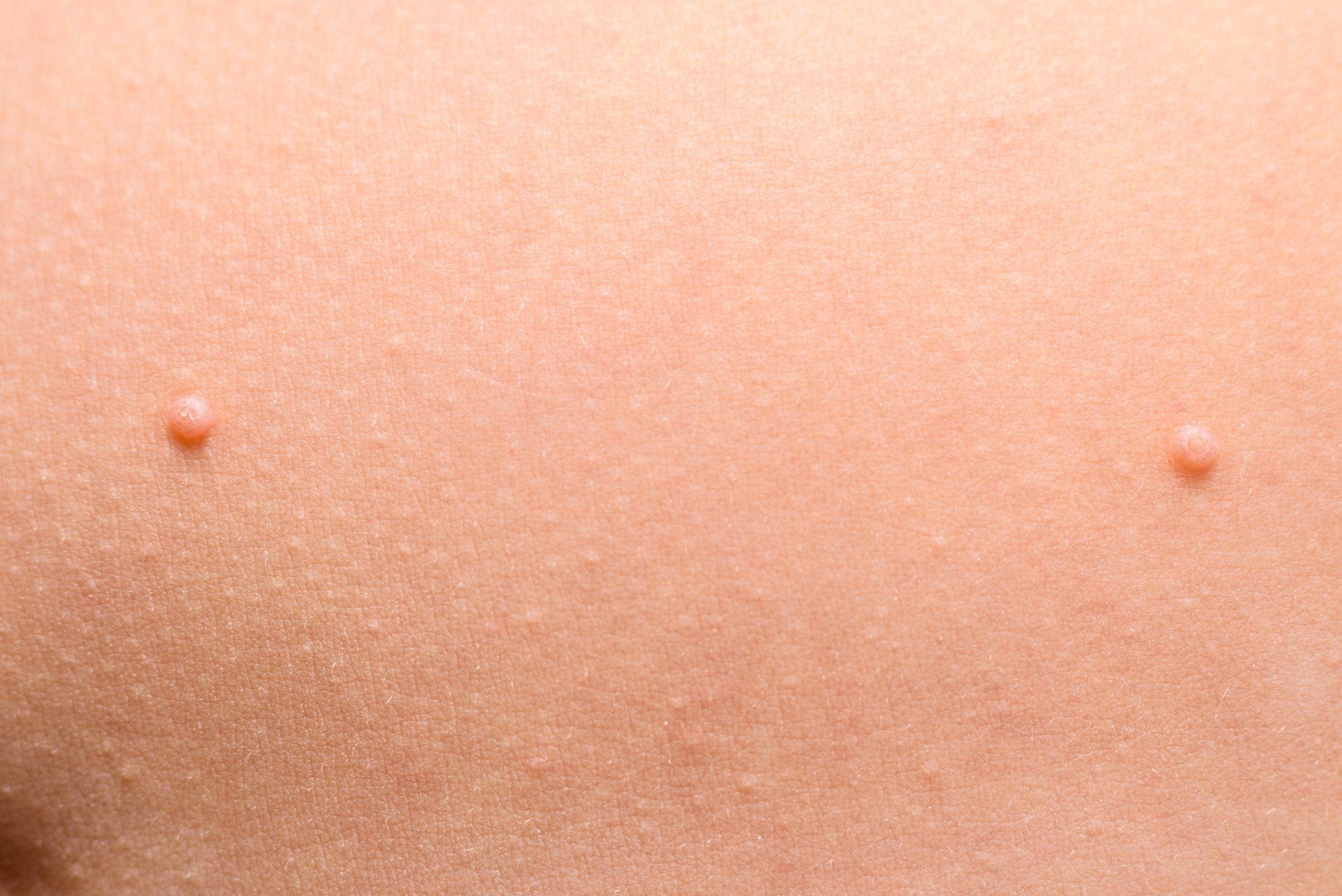 Mouth Lesions — Shelby Township, MI — Dermatology Specialists of Shelby Township