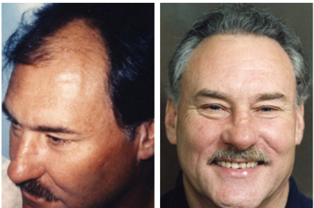 Hair Restoration — Shelby Township, MI — Dermatology Specialists of Shelby Township