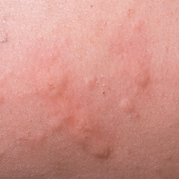 Autoimmune Conditions — Shelby Township, MI — Dermatology Specialists of Shelby Township