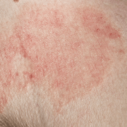 Eczema — Shelby Township, MI — Dermatology Specialists of Shelby Township
