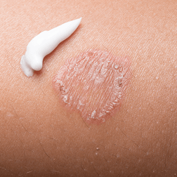 Fungal Skin Infections — Shelby Township, MI — Dermatology Specialists of Shelby Township