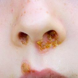 Impetigo — Shelby Township, MI — Dermatology Specialists of Shelby Township