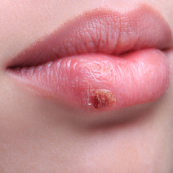 Mouth Lesions — Shelby Township, MI — Dermatology Specialists of Shelby Township