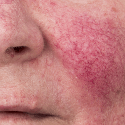 Rosacea — Shelby Township, MI — Dermatology Specialists of Shelby Township