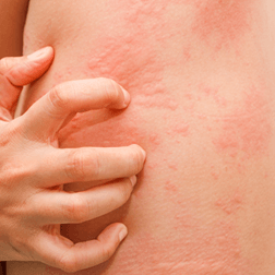 Rashes — Shelby Township, MI — Dermatology Specialists of Shelby Township