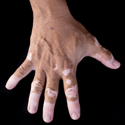 Vitiligo — Shelby Township, MI — Dermatology Specialists of Shelby Township